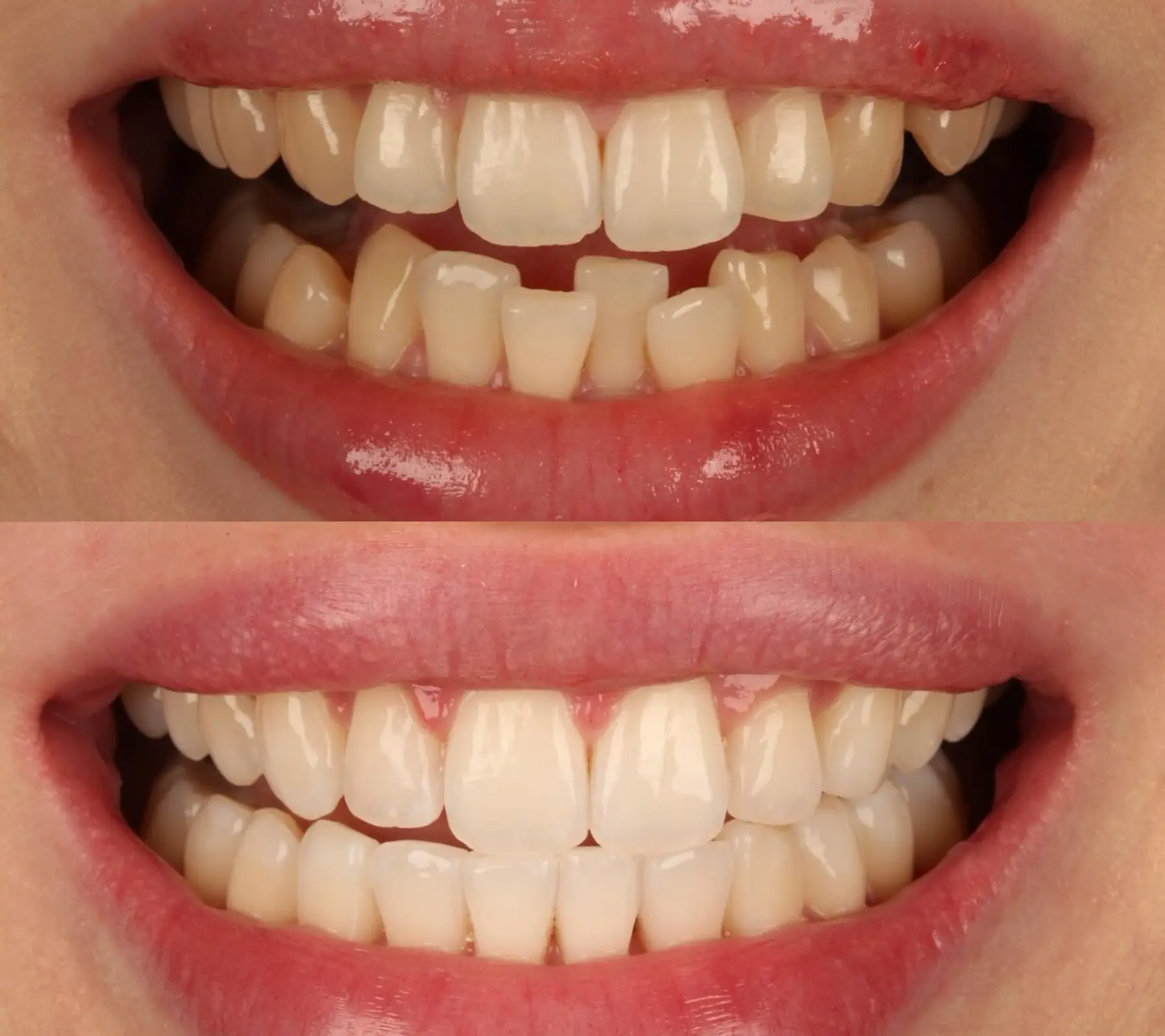 Invisalign, Whitening & Contouring