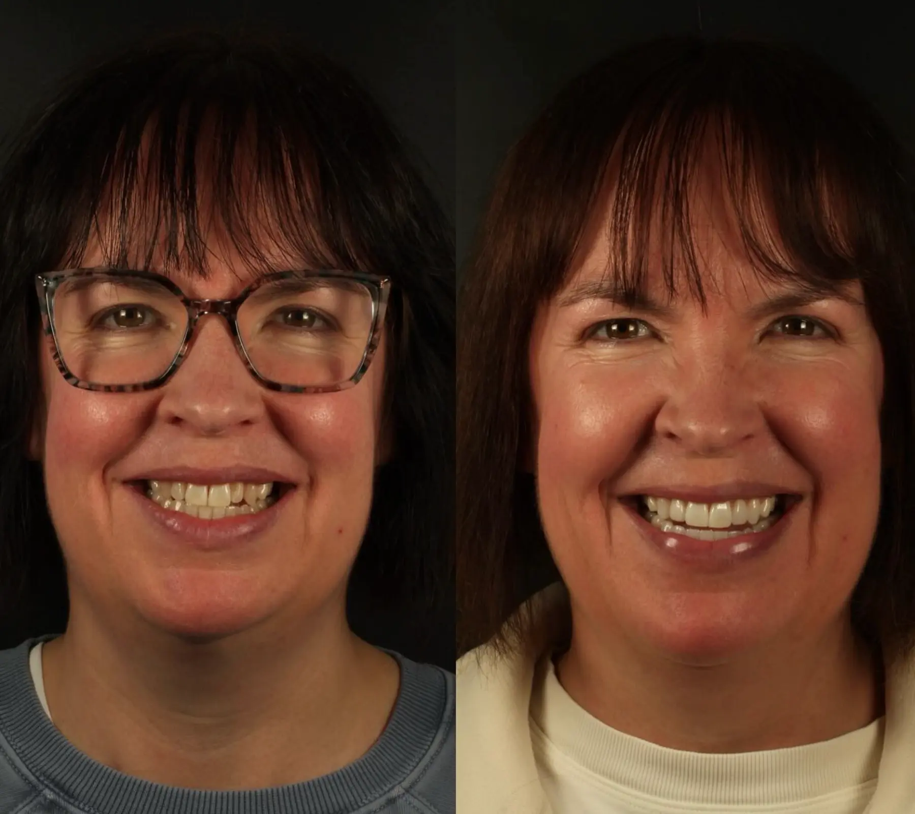 Invisalign, Whitening & Veneers
