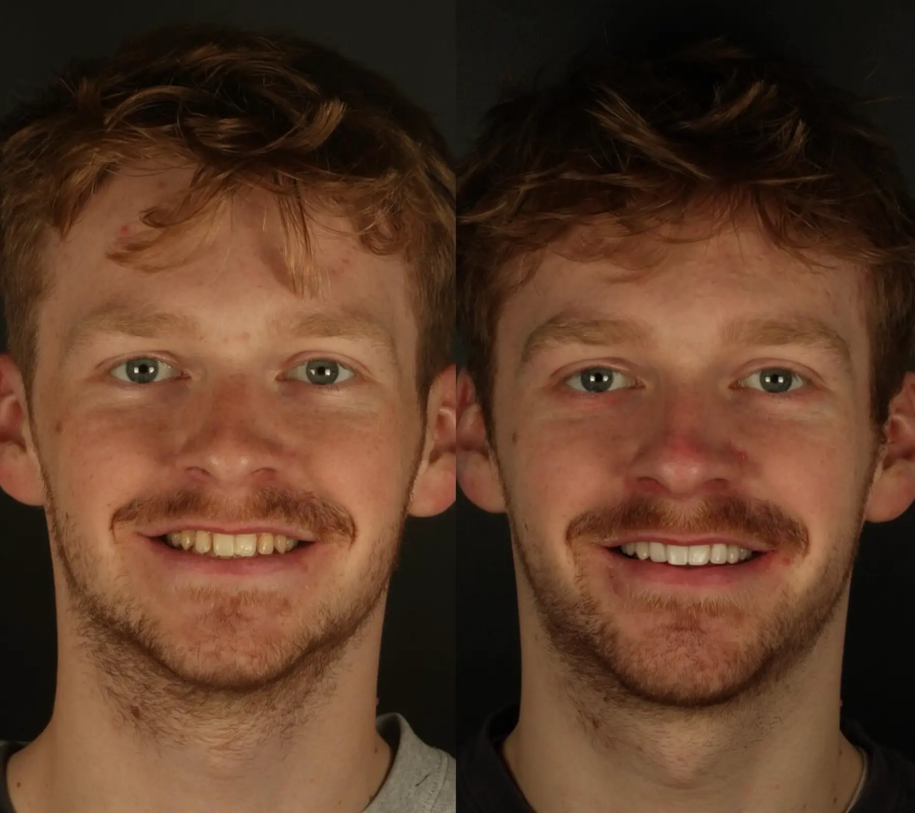 Whitening, Bonding & Veneers