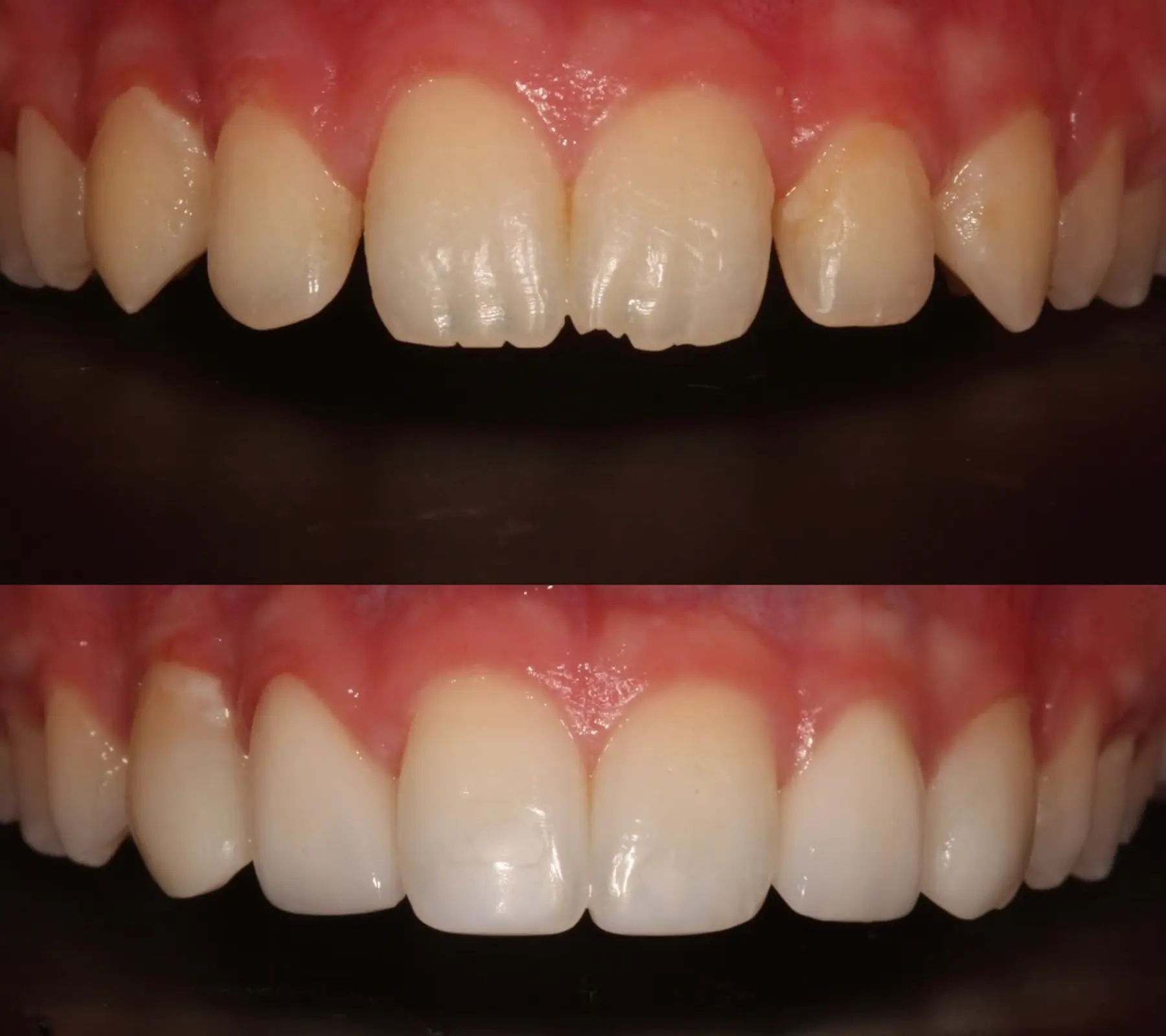 Composite Bonding & Porcelain Veneers