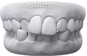 Crowded teeth