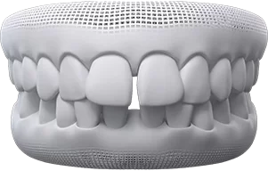 Gaps between teeth