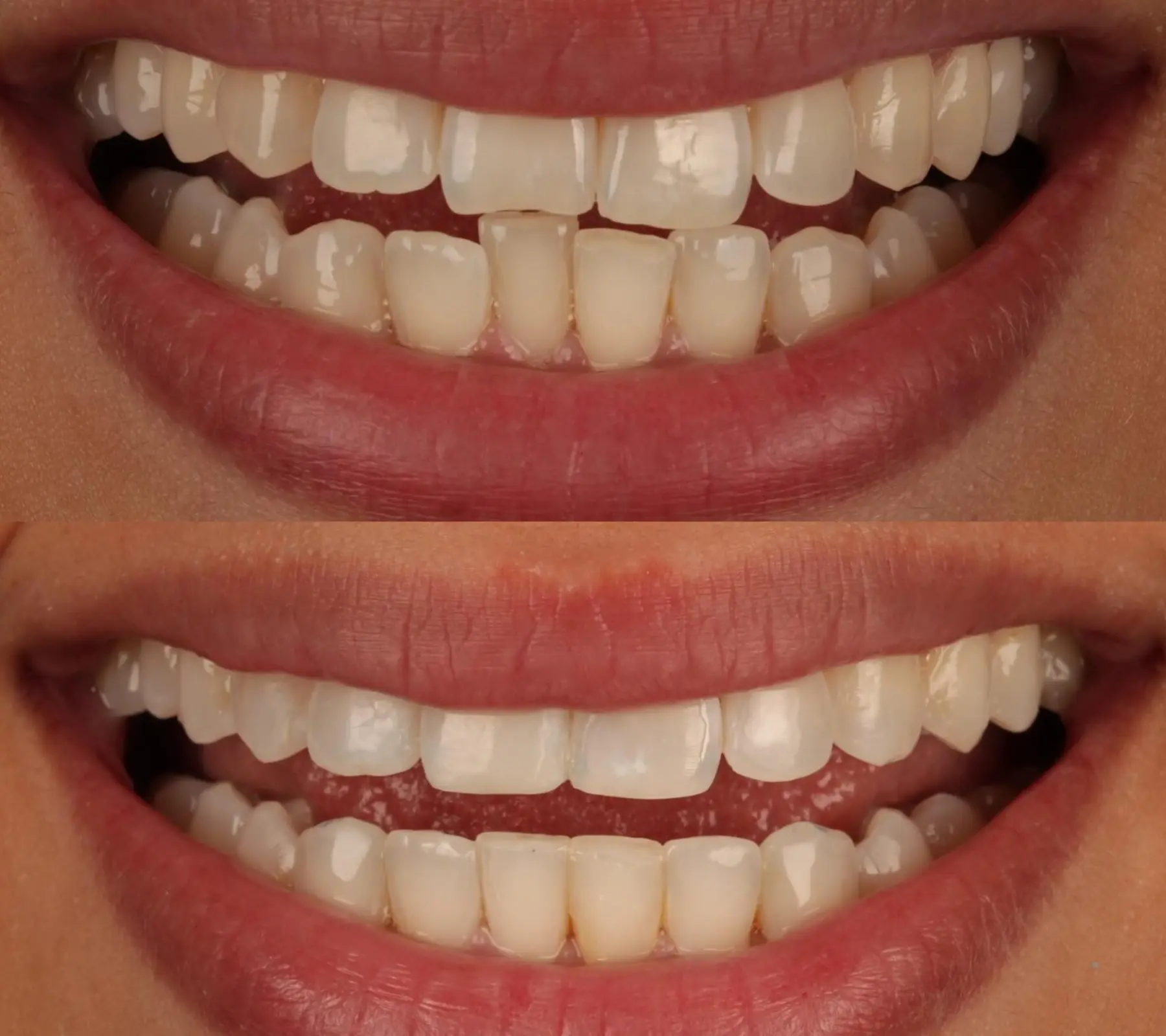 Invisalign, Whitening & Bonding