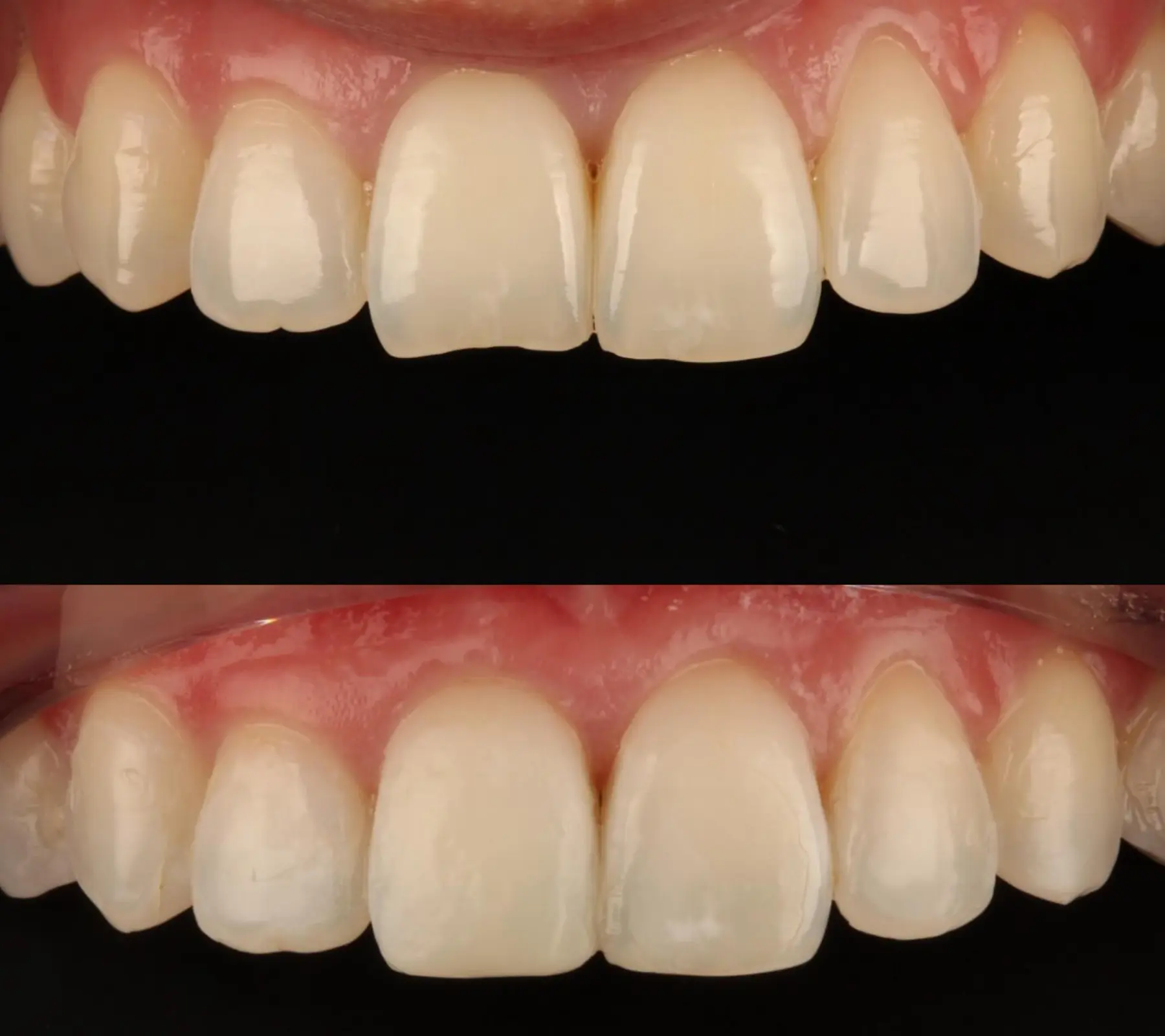 Invisalign, Whitening & Bonding