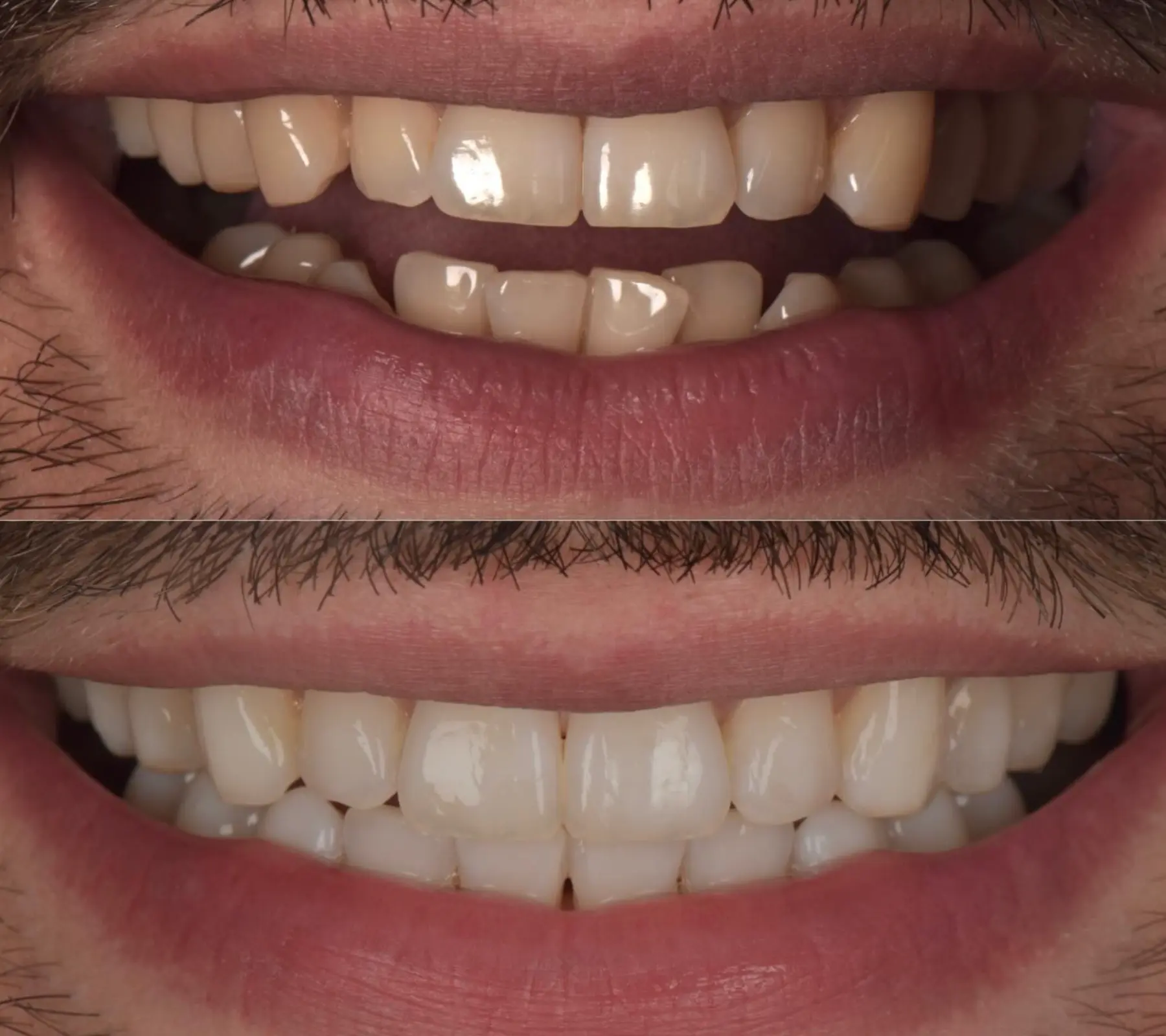 Invisalign & Teeth Whitening