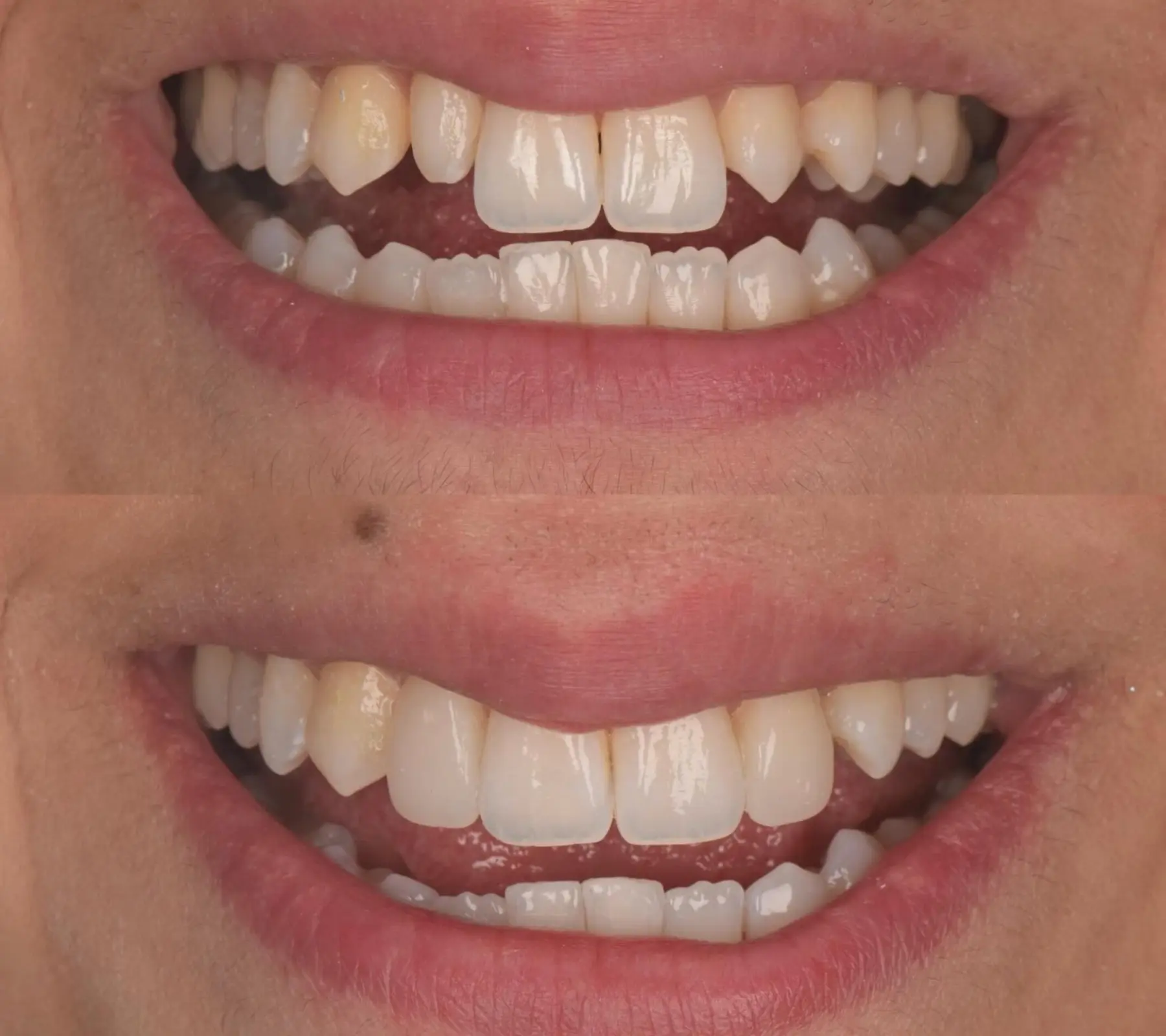 Invisalign & Bonding