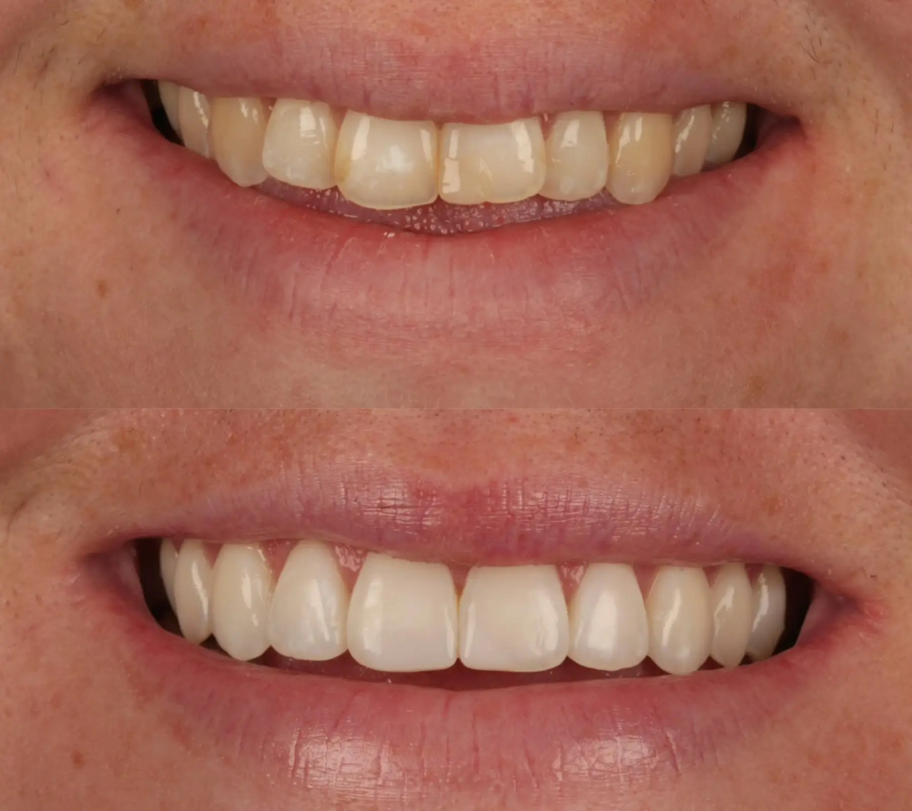 Invisalign, Whitening & Bonding