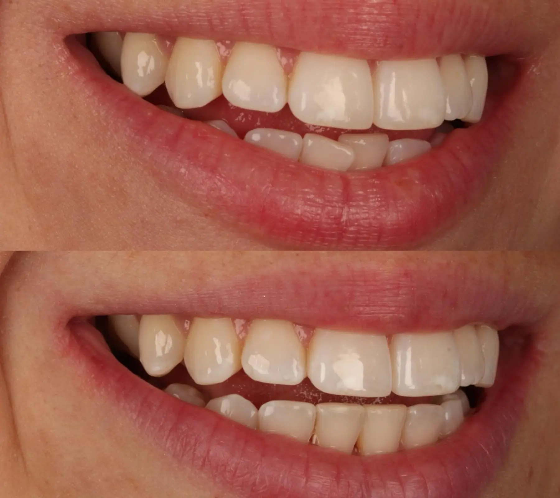 Invisalign