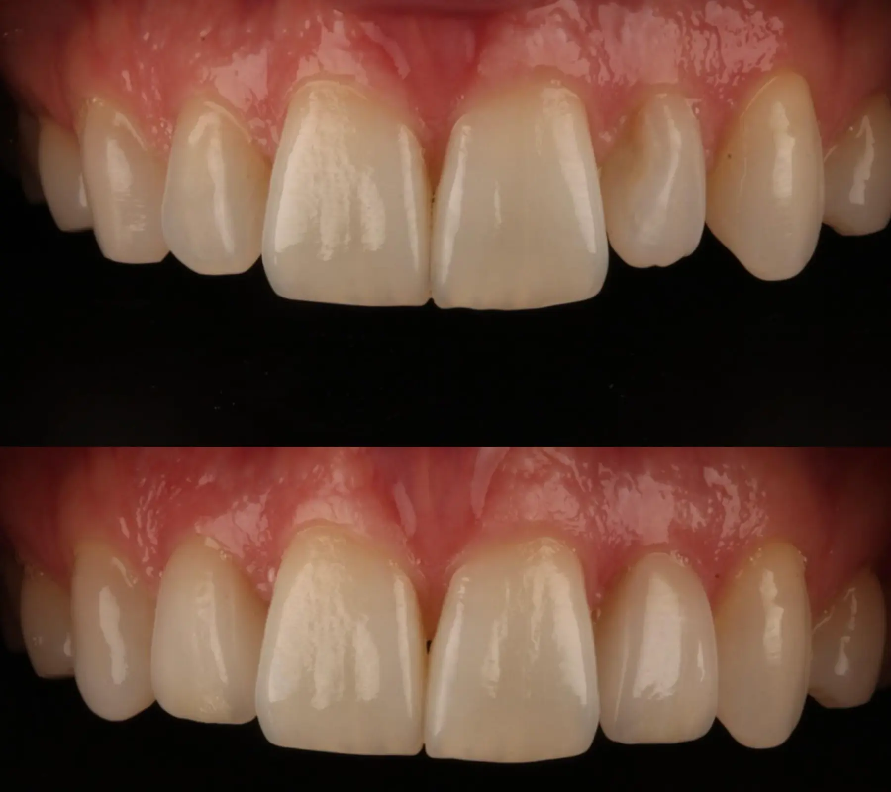 Porcelain Veneers