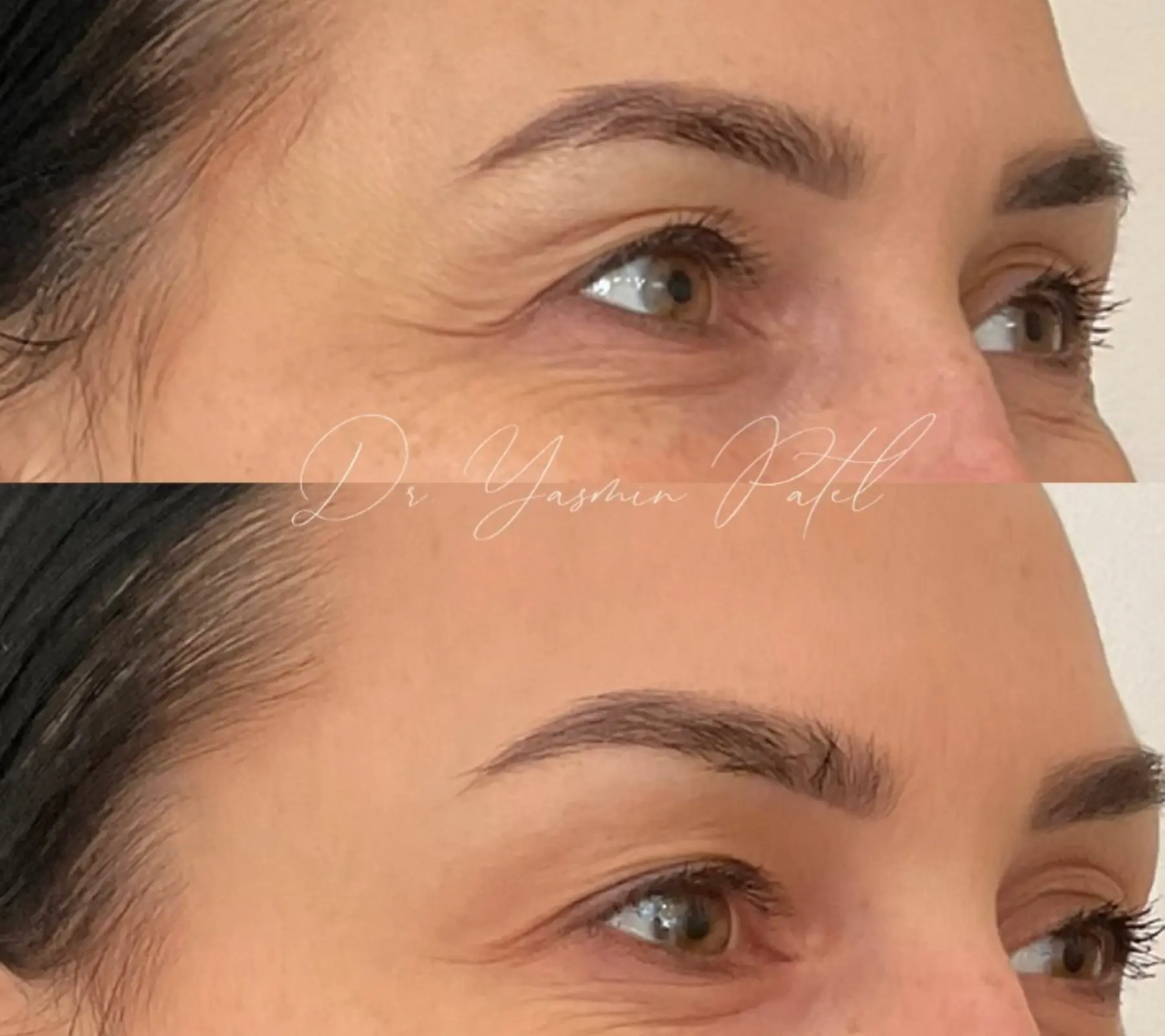 Chemical Brow Lift