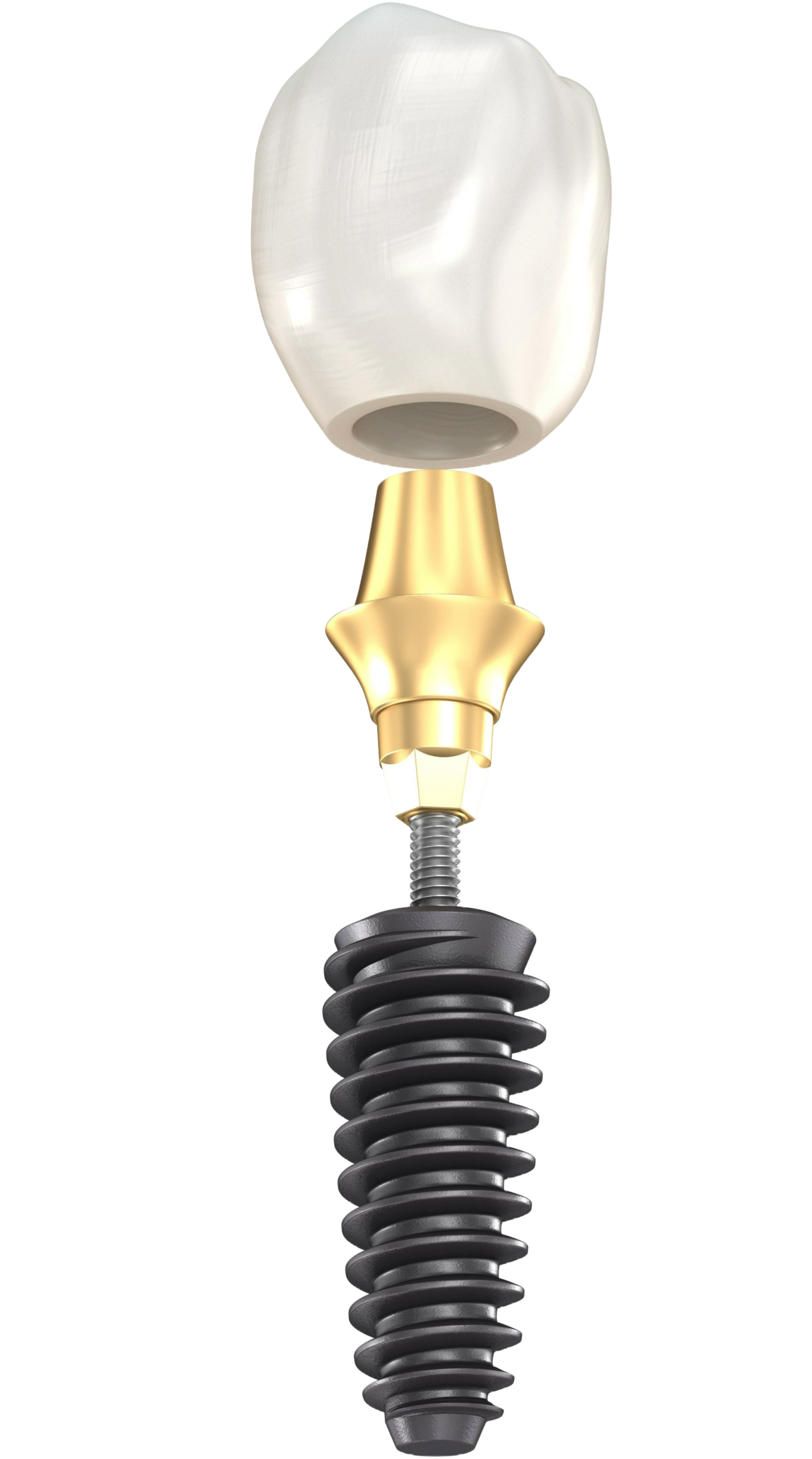 Dental implant components diagram