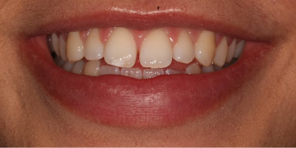 Gaps between teeth