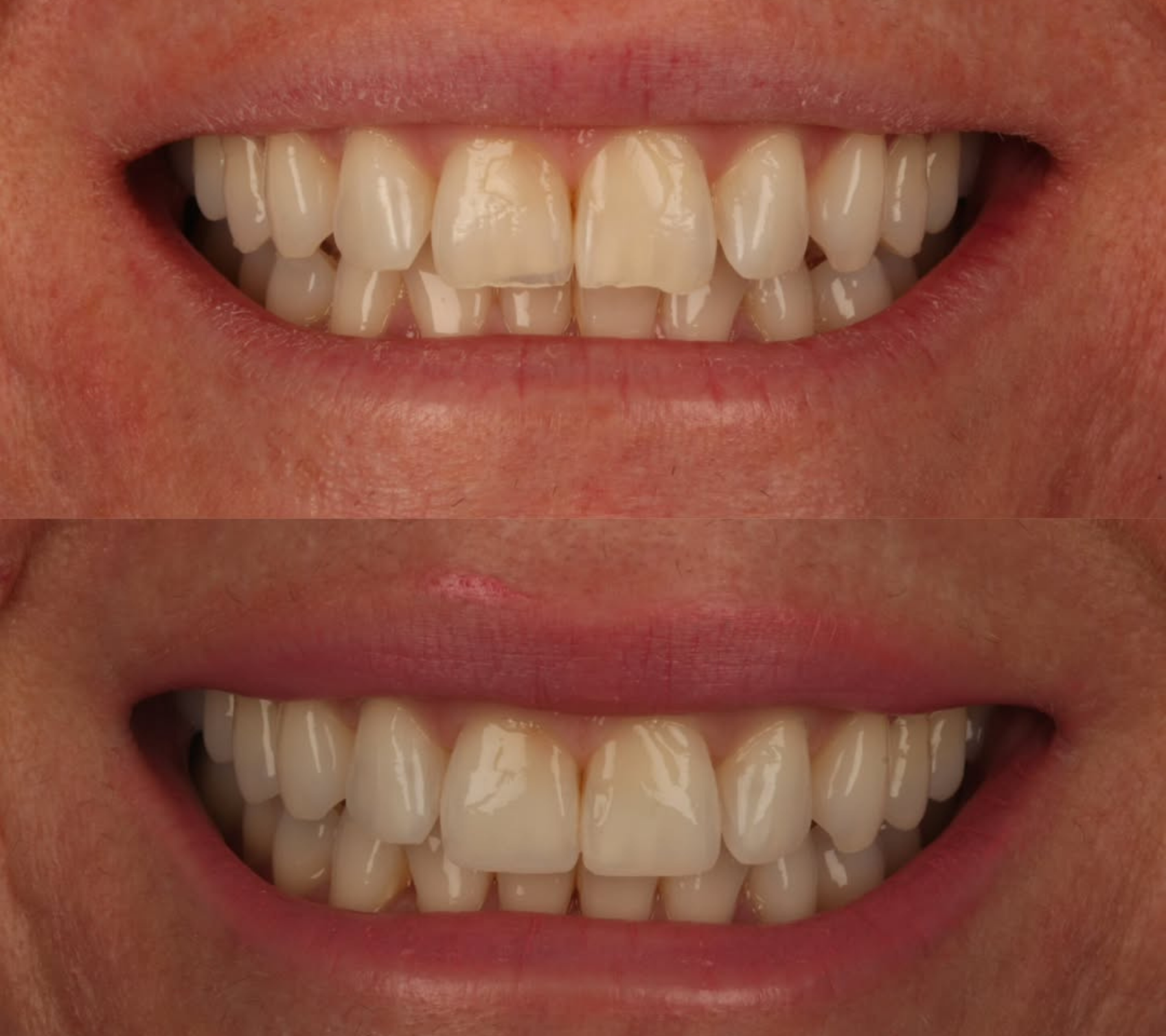 Invisalign & Bonding