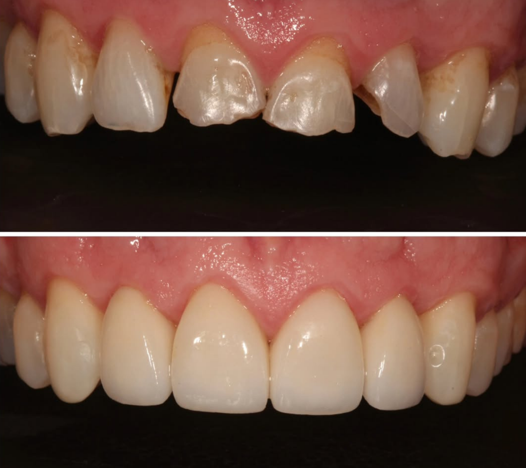 Invisalign, Teeth Whitening & Porcelain Veneers