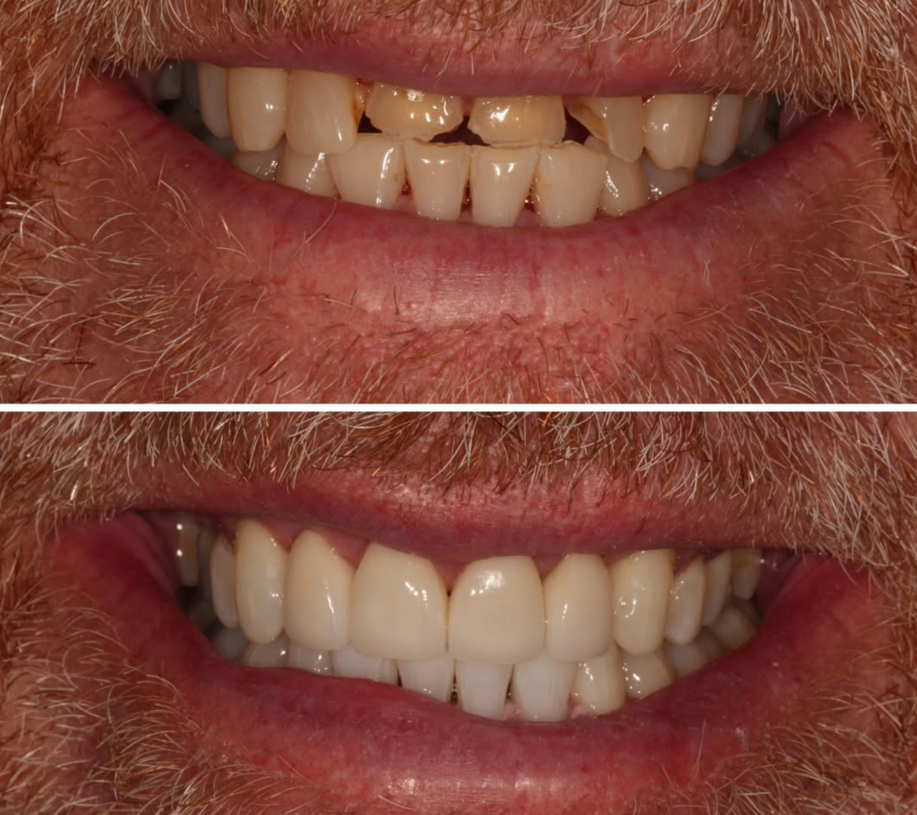 Invisalign, Whitening & Porcelain Veneers