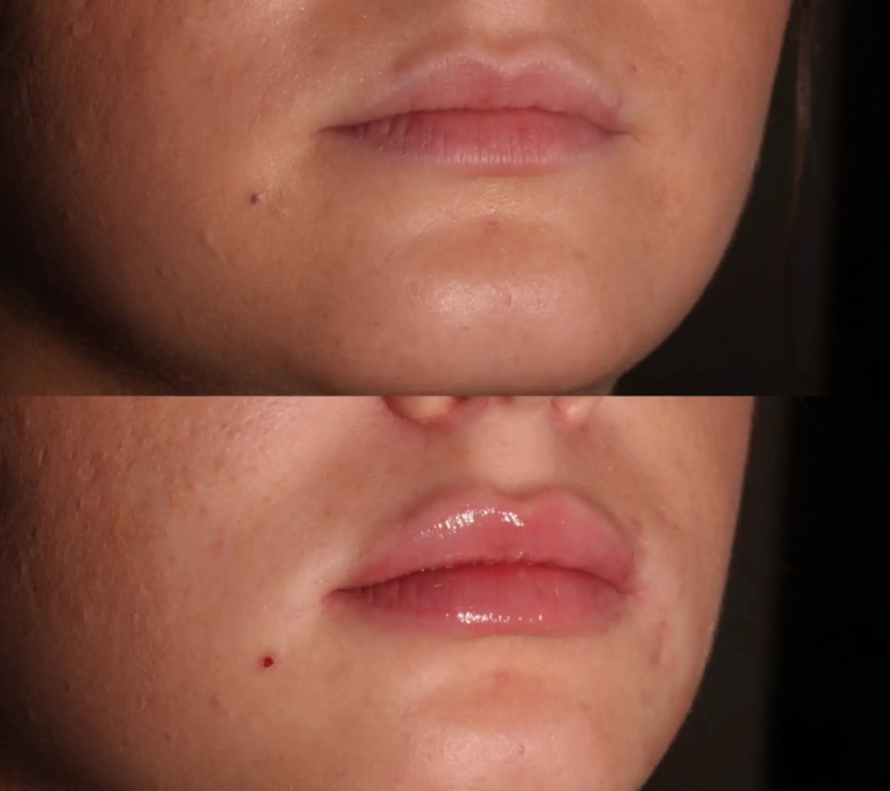 Lip Fillers