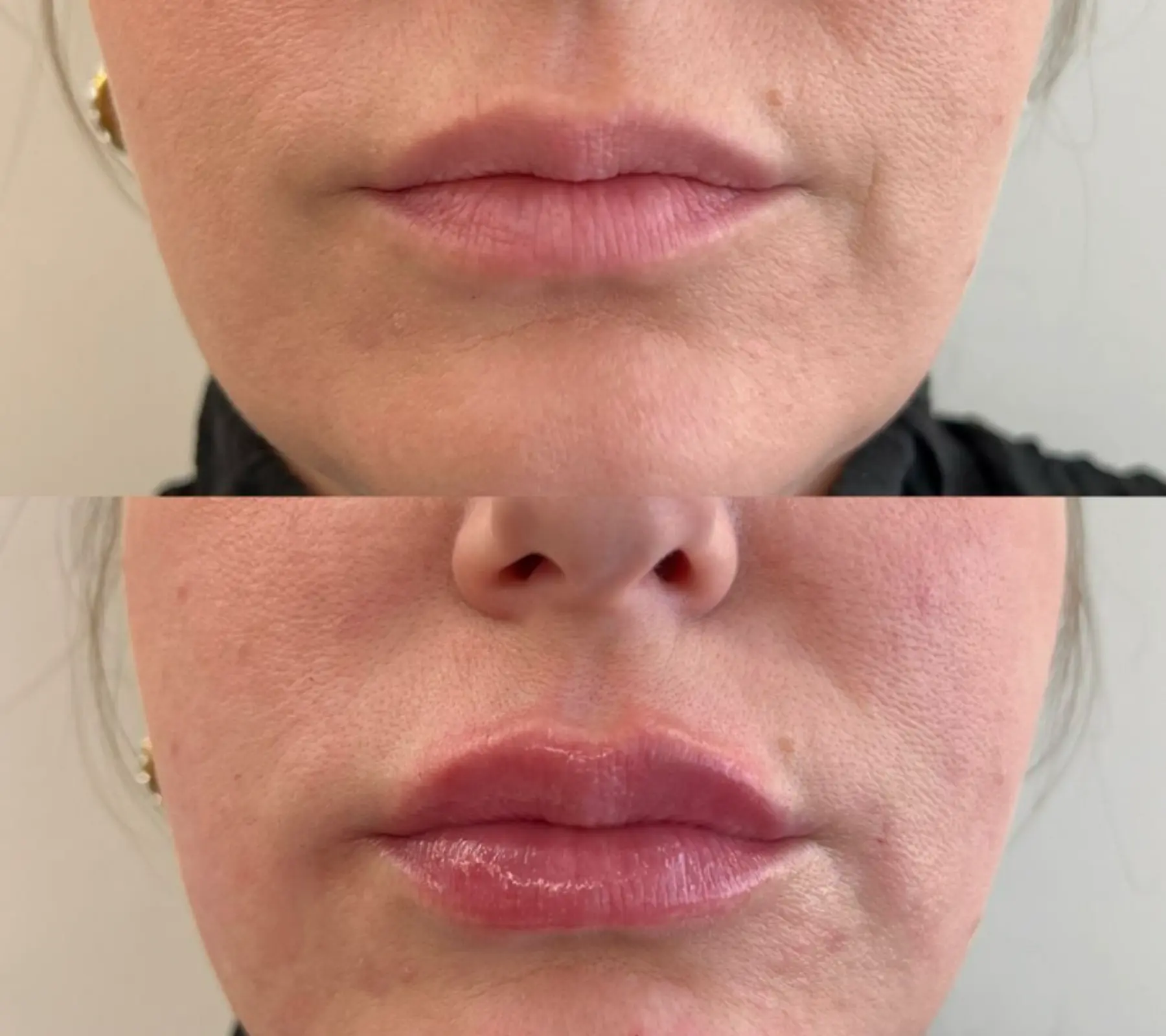 Lip Fillers