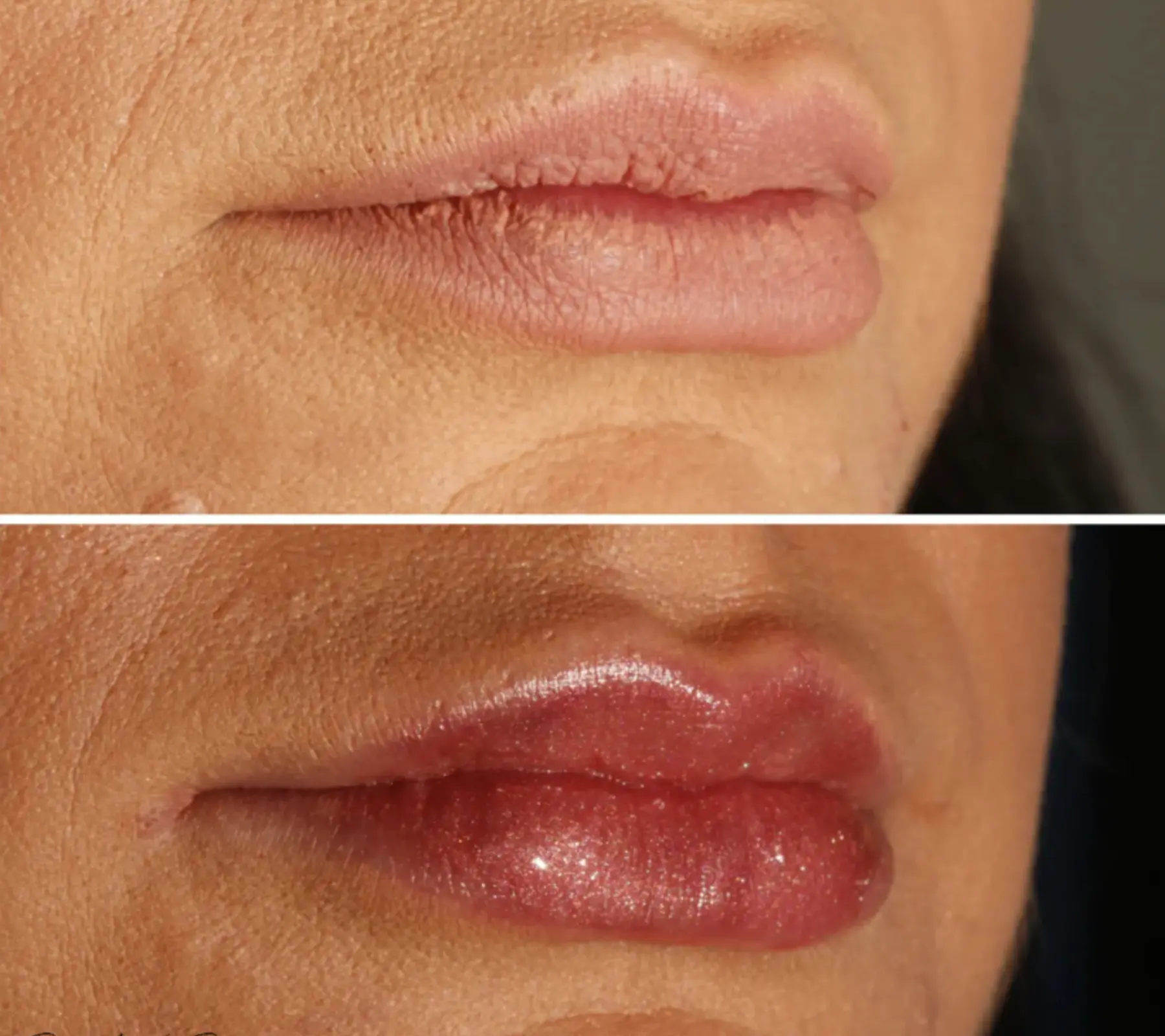 Lip Fillers