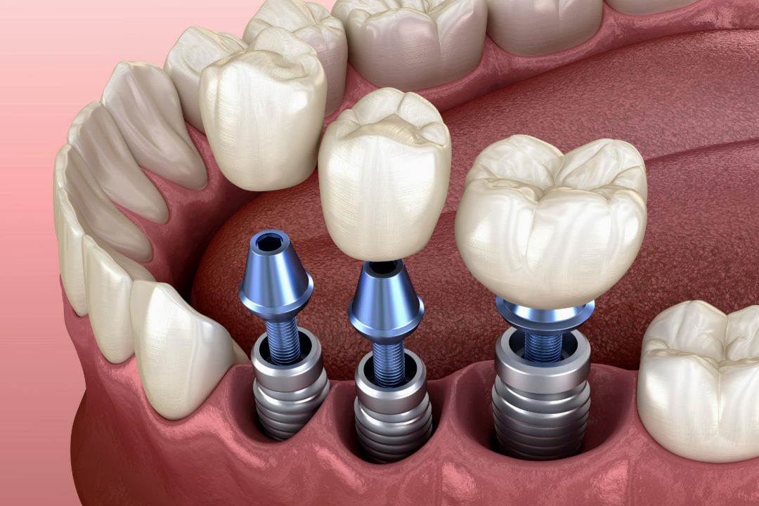 Dental implant at Parchment Street Dental Winchester