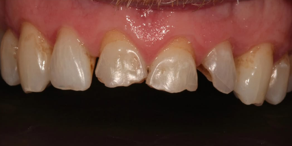 Damaged teeth