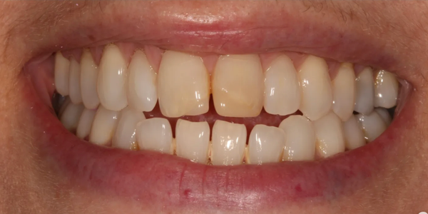 Discoloured teeth